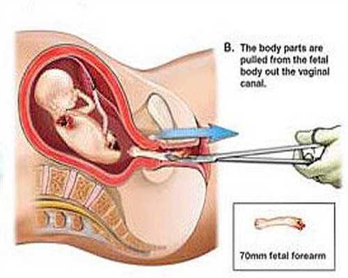 泰国生子：做了输卵管手术两个月可以代孕吗